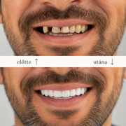 SMILEFIT PRO – NASTAVITEĽNÁ SADA ZUBNÝCH PROTÉZ PRE DOKONALÝ ÚSMEV