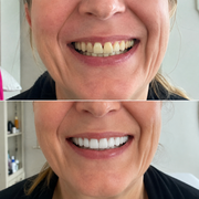 SMILEFIT PRO – NASTAVITEĽNÁ SADA ZUBNÝCH PROTÉZ PRE DOKONALÝ ÚSMEV